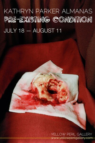 ypg_preexisting_smPost